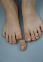 Custom Silicone Big Toe (Hallux) Prosthesis