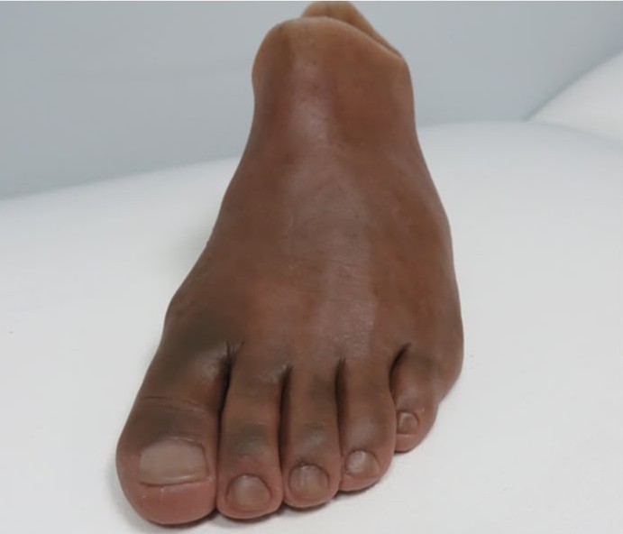 Full Foot Silicone Prosthesis