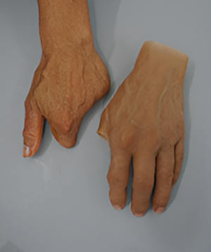 Full Hand Silicone Prosthesis