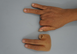 A top-down view of a patient's hand with a partial index finger amputation, shown next to a custom-crafted, wide-edged silicone prosthesis designed to fit securely and blend seamlessly into the hand's natural contours.