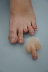 A top-down view of a patient's foot with partial toe amputations, displayed next to a custom-crafted silicone prosthesis. The multi-toe prosthetic piece features hollow sleeves and a wide, tapered base designed to securely fit over the residual digits and restore the foot's natural appearance.